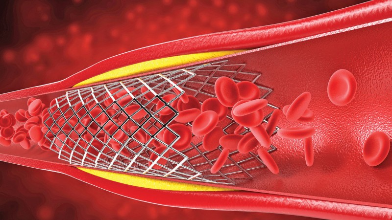 اِستِنت (Stent) رگ قلب چیست؟